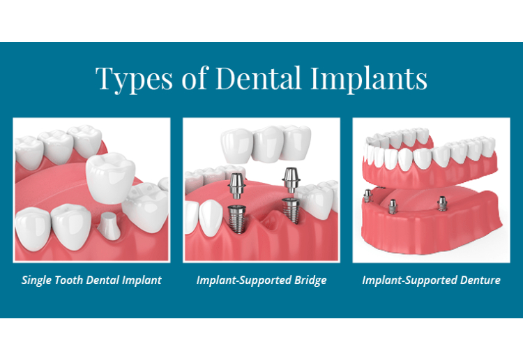 implants in dwarka